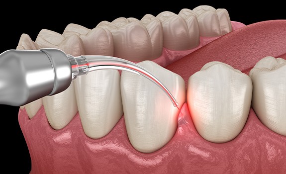 a dental laser removing damaged gum tissue